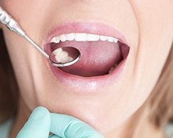 Prevencia pred zubným kazom